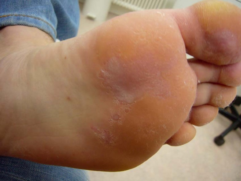 Huidafwijkingen Aan De Voeten Springerlink