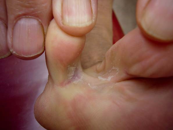 Huidafwijkingen Aan De Voeten Springerlink