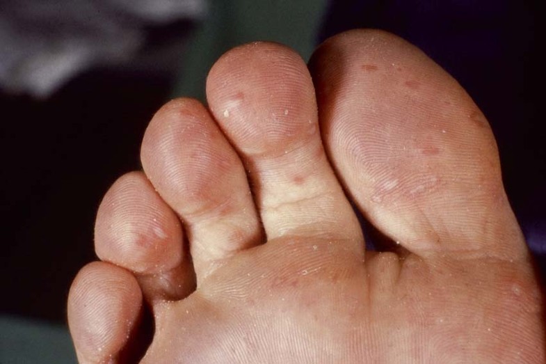 Huidafwijkingen Aan De Voeten Springerlink