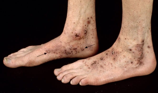 artralgie voeten)