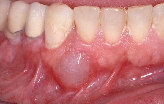 Het Tandvlees En Het Slijmvlies Van De Kaakwallen Springerlink