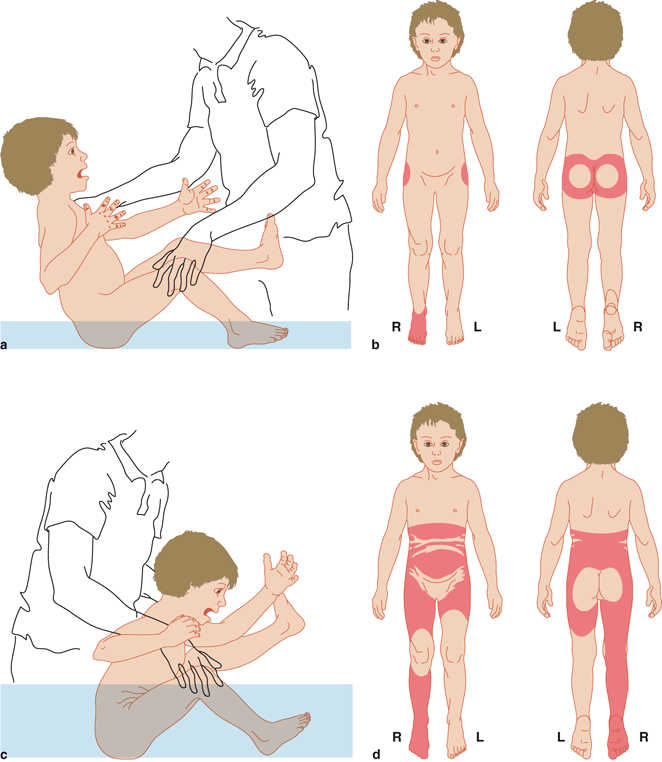 De Huid In De Differentiaaldiagnose Van Kindermishandeling Springerlink