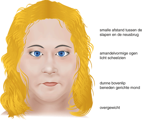 Oorzaken En Syndromen Bij Mensen Met Een Verstandelijke Beperking Springerlink