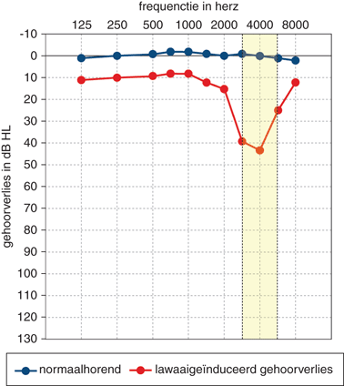 Tandartsen En Beroepsgerelateerde Lawaaislechthorendheid