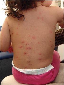 Waterpokken Varicella Springerlink