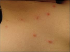 Waterpokken Varicella Springerlink