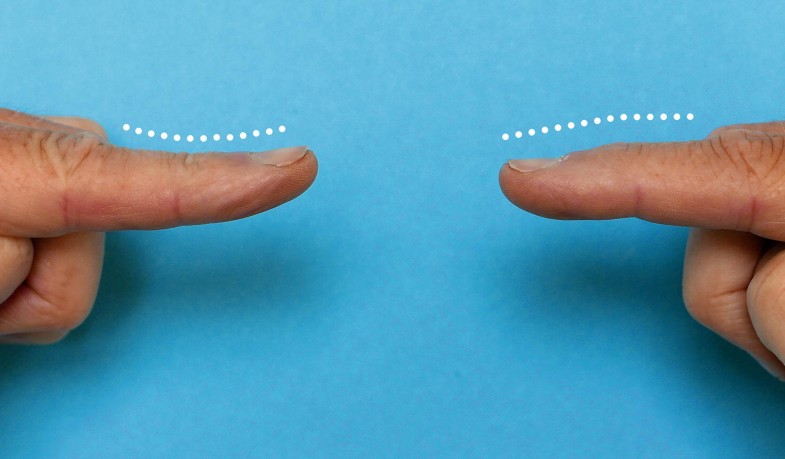 Mallet Finger Springerlink