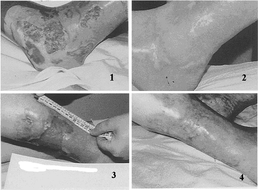 The Clinical Application Of Ozonetherapy Springerlink - 