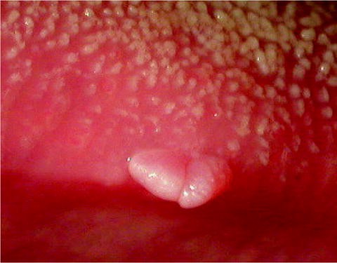 squamous vestibular papillomatosis treatment