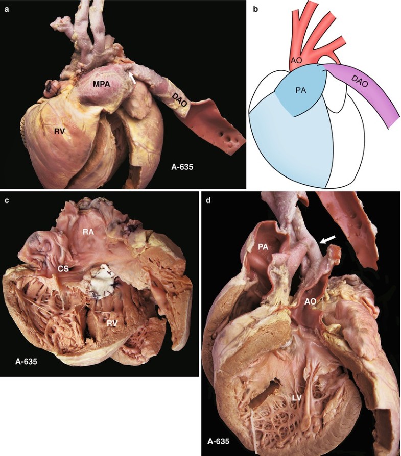 interrupted aortic arch support group interrupted aortic arch support group