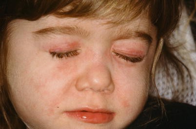 Autoimmune Dermatoses Springerlink