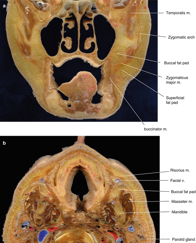 Clinical Anatomy of the Midface for Filler Injection | SpringerLink