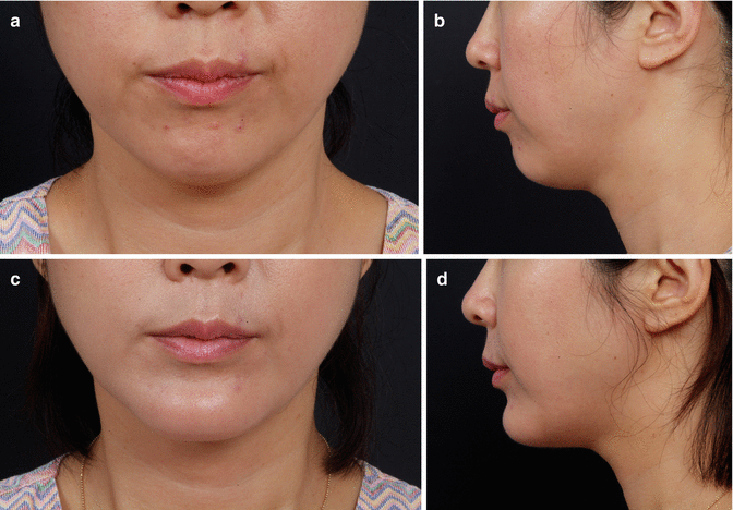 mentolabial fold filler