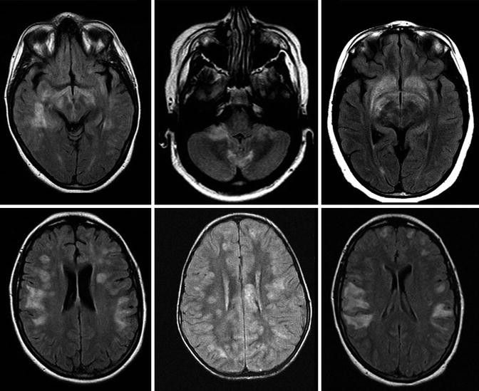 Childhood Central Nervous System Vasculitis | SpringerLink