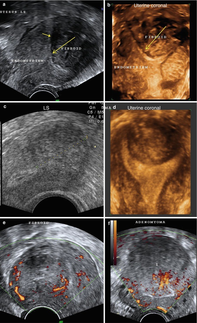 Ultrasound Evaluation Of Myometrium Springerlink