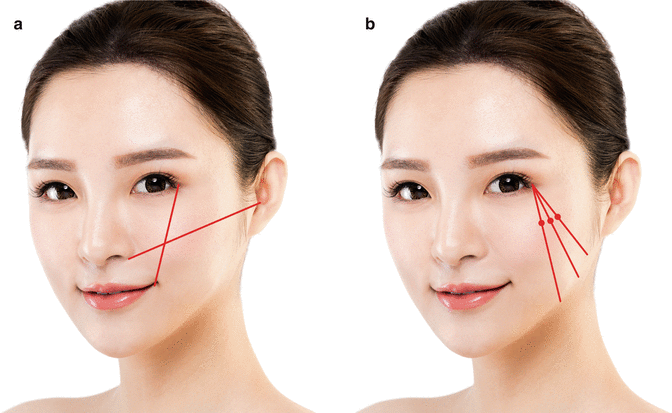 Standard Zygoma Reduction With Intraoral Approach Springerlink