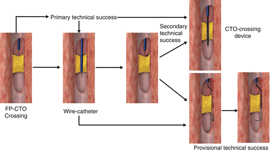 Femoropopliteal Artery Chronic Total Occlusion Intervention - 