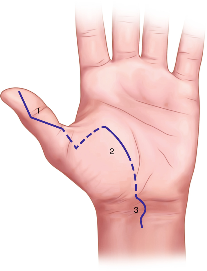 brunner type incision