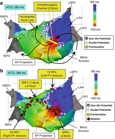 Outcomes Following Catheter Ablation Of Atrial Fibrillation In The Uk A Single Centre Cohort Analysis The British Journal Of Cardiology