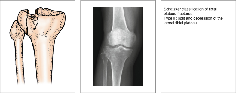 Non displaced tibial plateau fracture