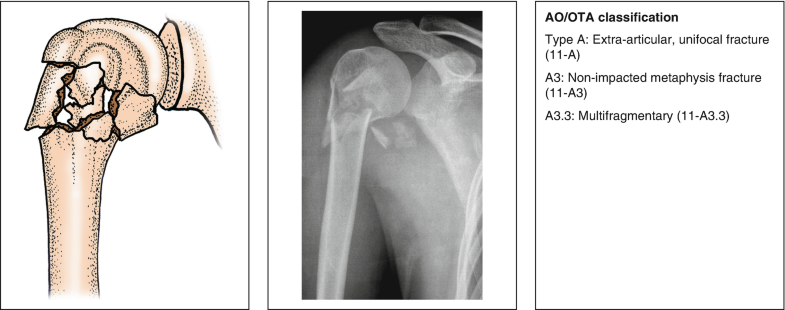 Classification Of Humeral Fractures Springerlink