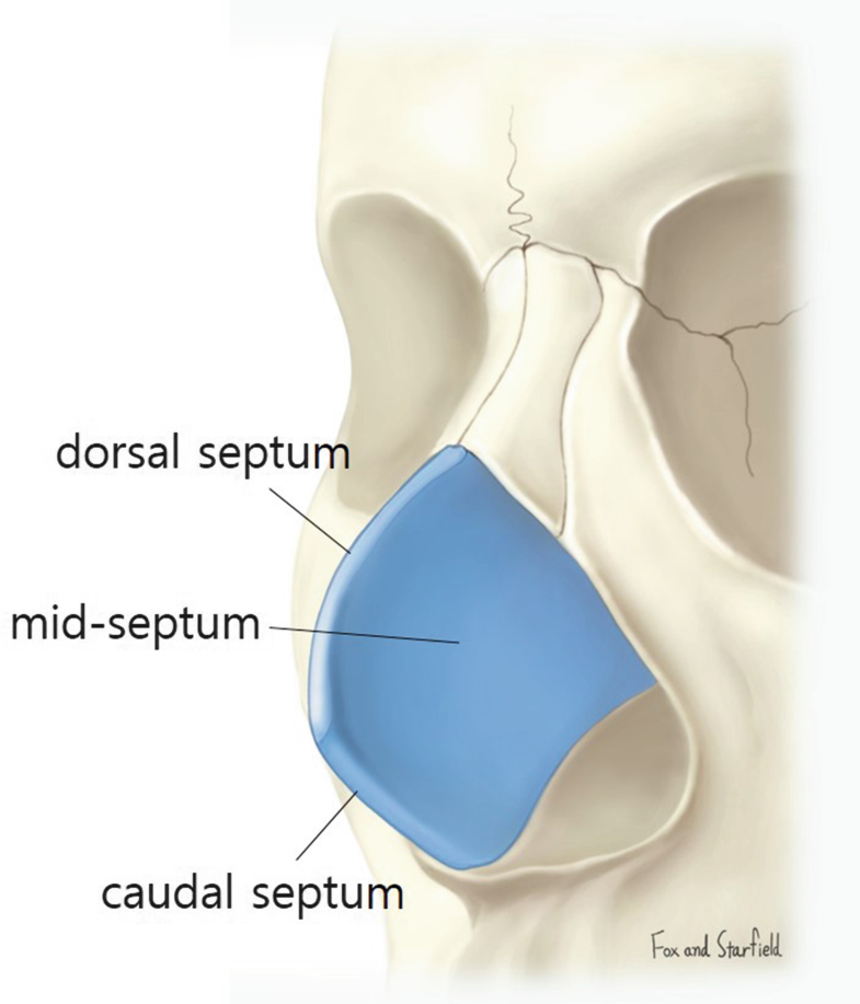 deviated nose correction and functional rhinoplasty springerlink