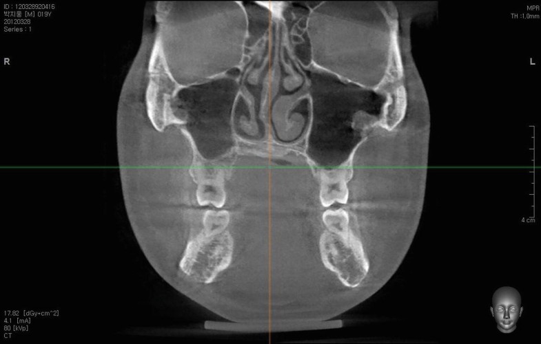 deviated nose correction and functional rhinoplasty springerlink