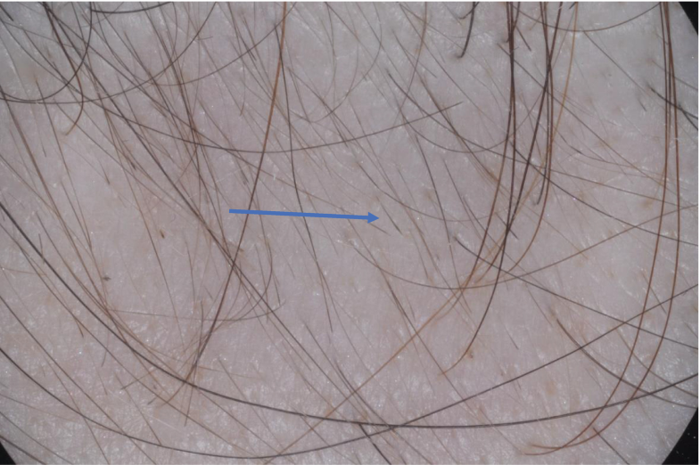 Trichoscopy Dermoscopy Hair Springerlink