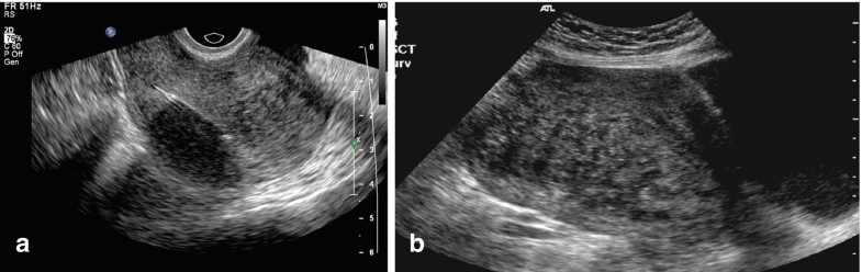 Ultrasound Manifestation And Classification Of Adenomyosis Springerlink