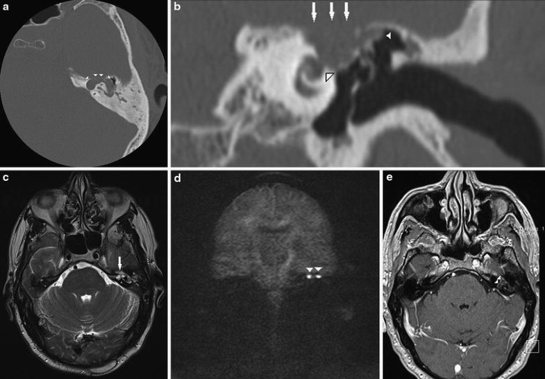 Холестеатома мрт картина