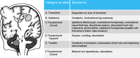 Herniation Rosh Brain Herniation Clinical Indicators – OQGPBB