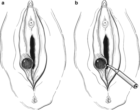 how to burst a bartholin cyst at home how to burst a bartholin cyst at home