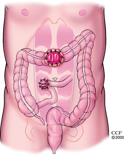 Colostomy: Types, Indications, Formation, and Reversal | SpringerLink