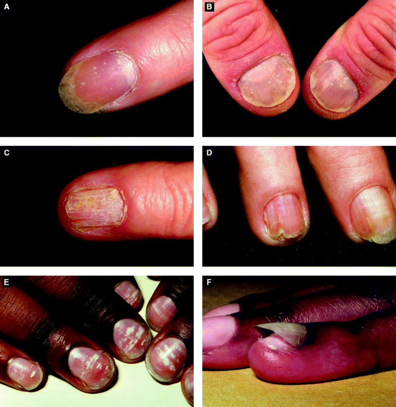 right thumb nail injury icd 10