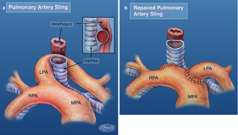 Vascular Rings, Tracheoplasty, and Pulmonary Artery Sling | SpringerLink