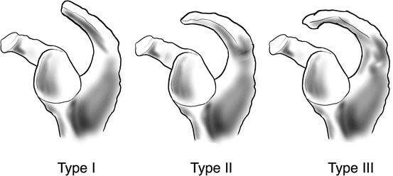 Acromion Morphology | SpringerLink