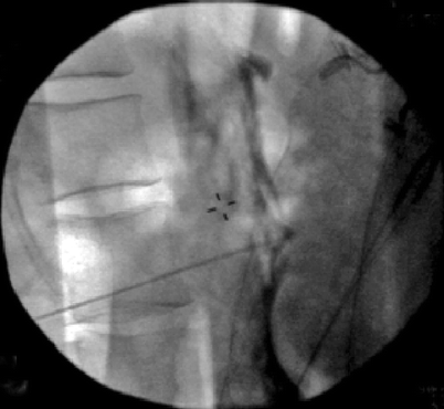 block plexus celiac nerve splanchnic neurolysis fig