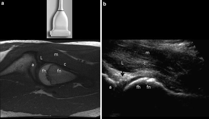Ultrasound of the Hip | SpringerLink