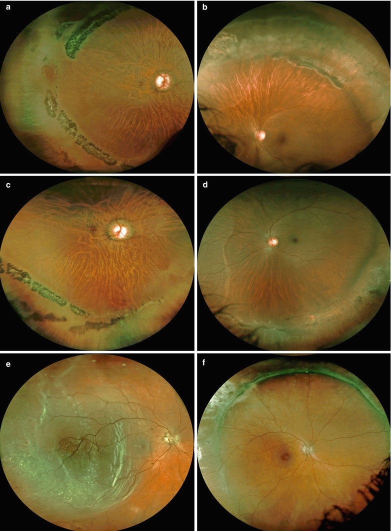 retinal atrophic hole