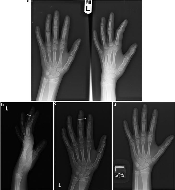 Pediatric Phalanx Fractures: Evaluation and Management ...
