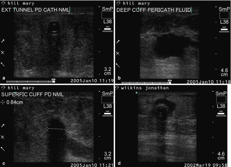 Operative Considerations for Peritoneal Dialysis Catheter SpringerLink
