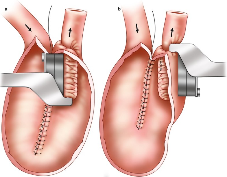 Continent Ileostomy | SpringerLink