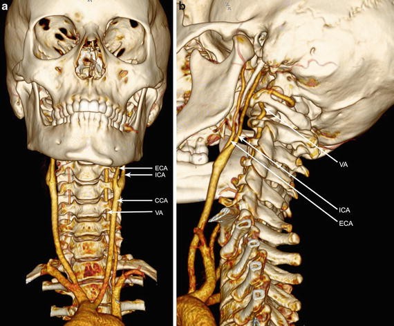 Anatomy of the Neck Arteries | SpringerLink