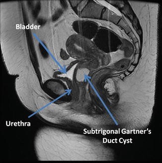Excision of Vaginal Cysts SpringerLink