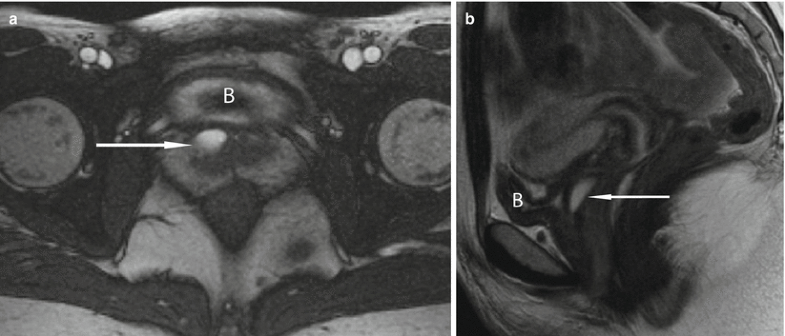 Cross-Sectional Imaging of the Female Urethra | SpringerLink