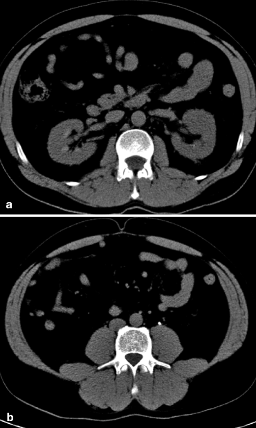 non obstructive left renal calculus non obstructive left renal calculus