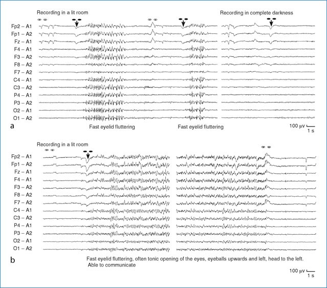 Flashing Lights Absence Seizures