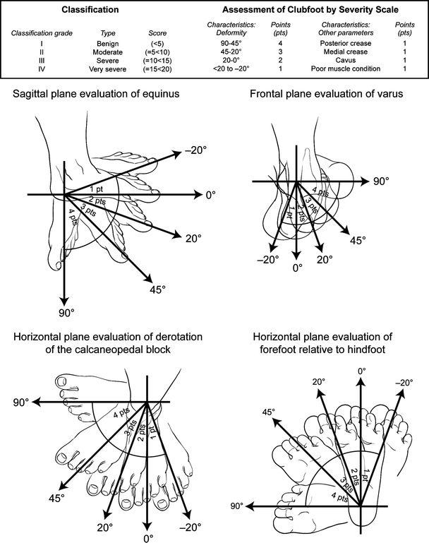 The Clubfoot Congenital Talipes Equinovarus SpringerLink