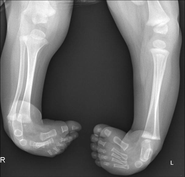 The Clubfoot: Congenital Talipes Equinovarus | SpringerLink
