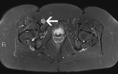 Diagnosis of a Lump in the Groin in the Adult | SpringerLink